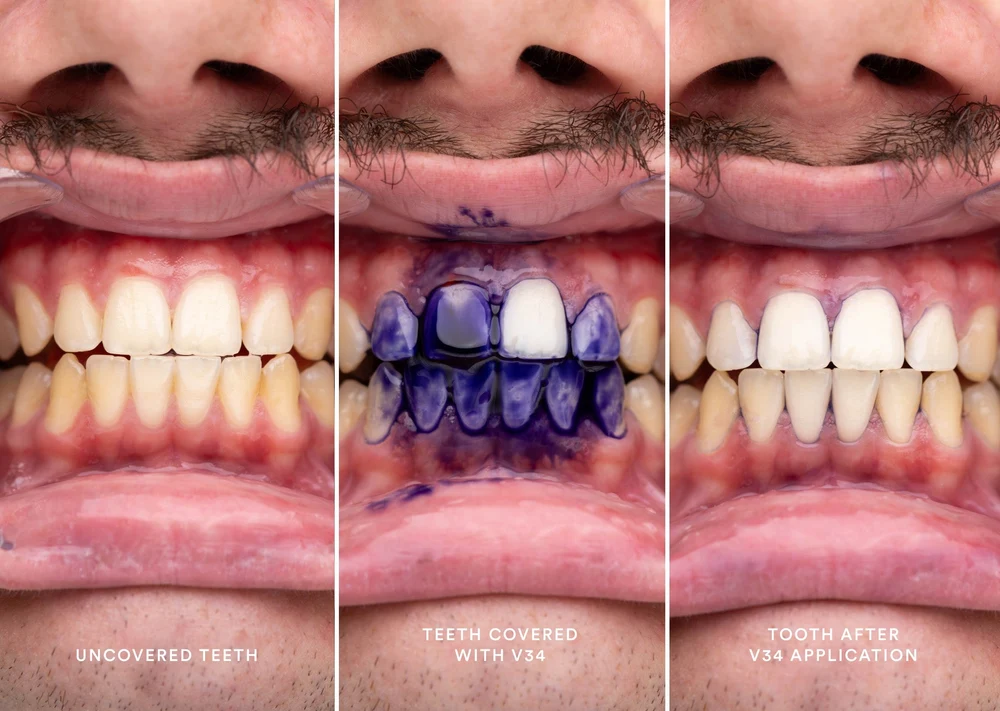 Dientes antes, durante y después de aplicar el sérum V34